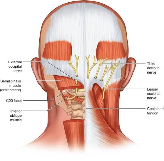 Oksipital Nöralji Nedir? (Göze ve alına vuran boyun kökenli baş ağrıları)