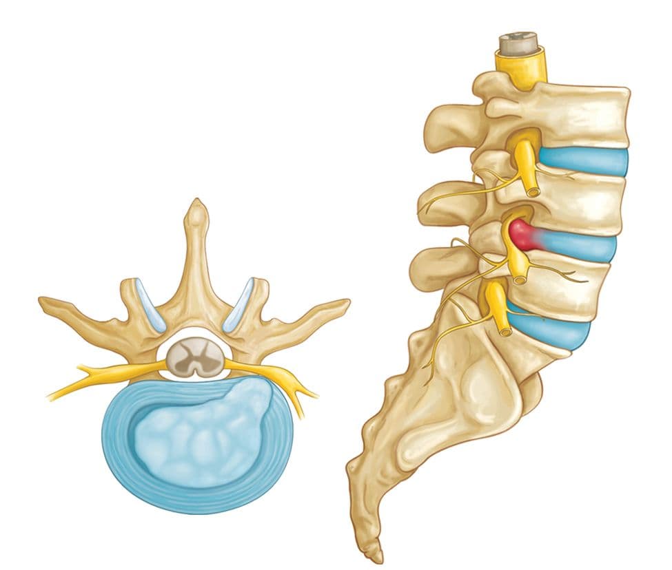 How Do Lumbar and Cervical Hernias Form?