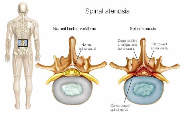 What is Spinal Stenosis?